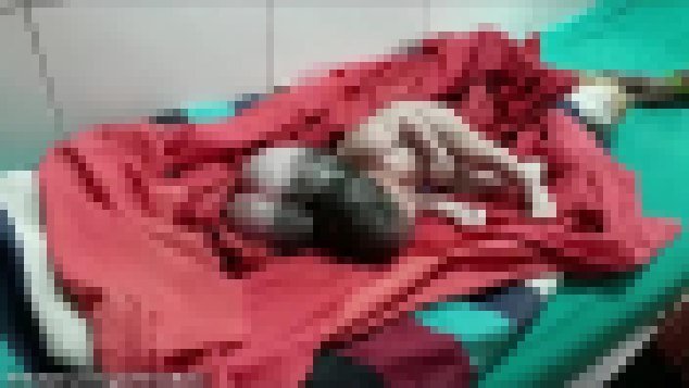 तीन वटा टाउको भएको शिशुको जन्म