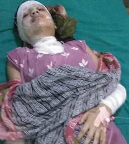 वीरगन्जमा १५ वर्षीया किशोरीमाथि एसिड प्रहार