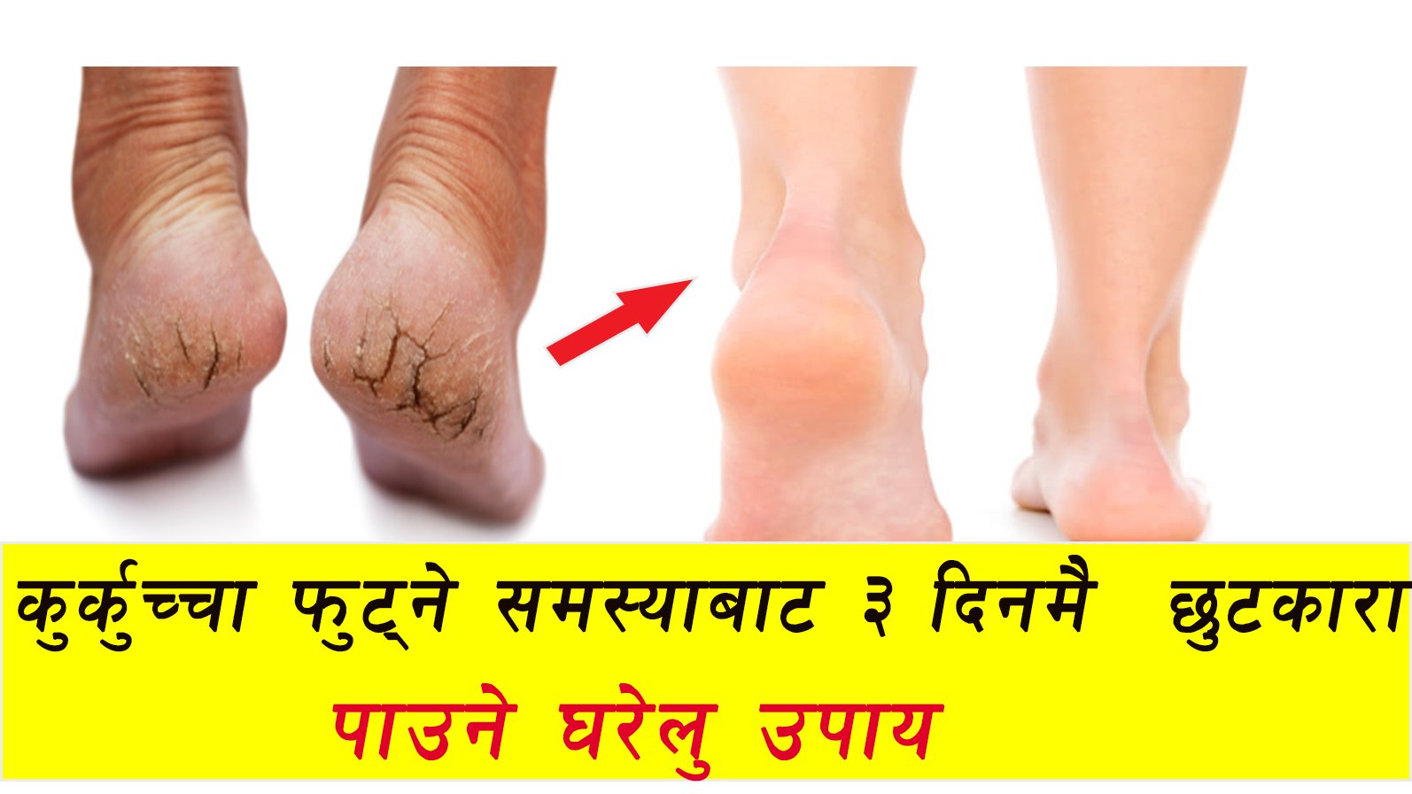 चिसोमौसममा खुट्टाको कुर्कुच्चा फुट्ने समस्याबाट छुटकारा पाउने उपाय………